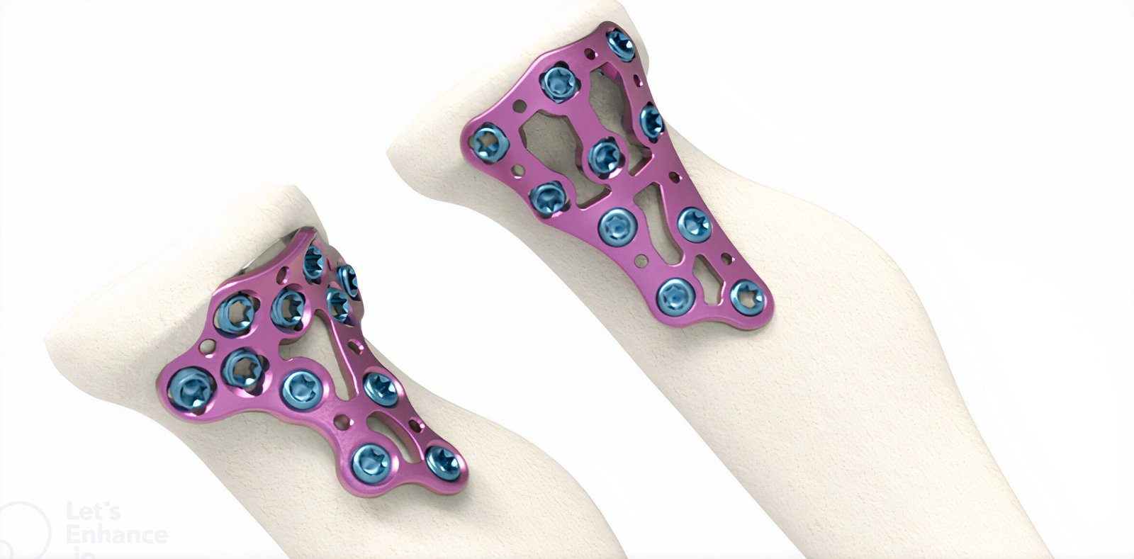 CABEZA RADIAL VA-LCP