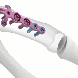 OVIEDO - PLACA DE GANCHO PARA FRACTURA ROLANDO Y PLACA PARA FRACTURA POR AVULSIÓN