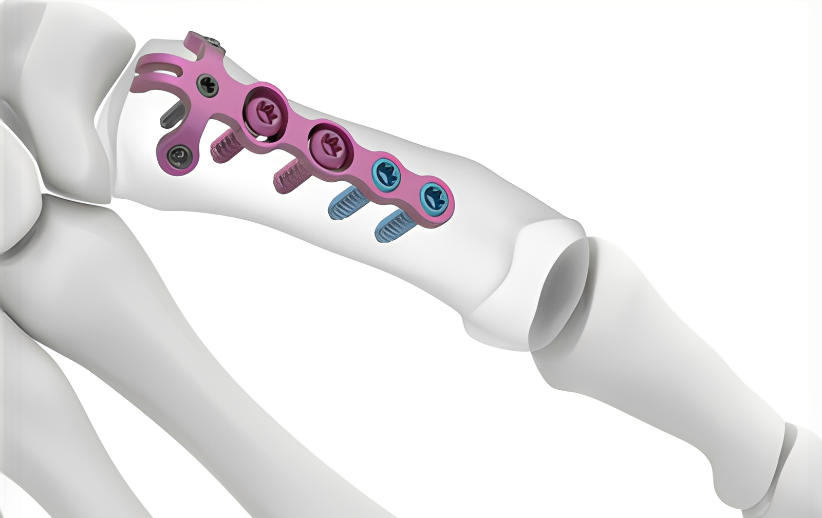 OVIEDO - PLACA DE GANCHO PARA FRACTURA ROLANDO Y PLACA PARA FRACTURA POR AVULSIÓN