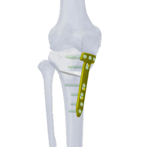 PLACA DE OSTEOTOMÍA PERIRRODILLAL LENA LCP